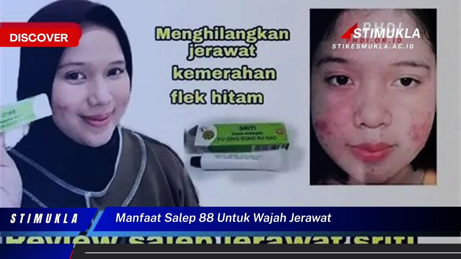 manfaat salep 88 untuk wajah jerawat